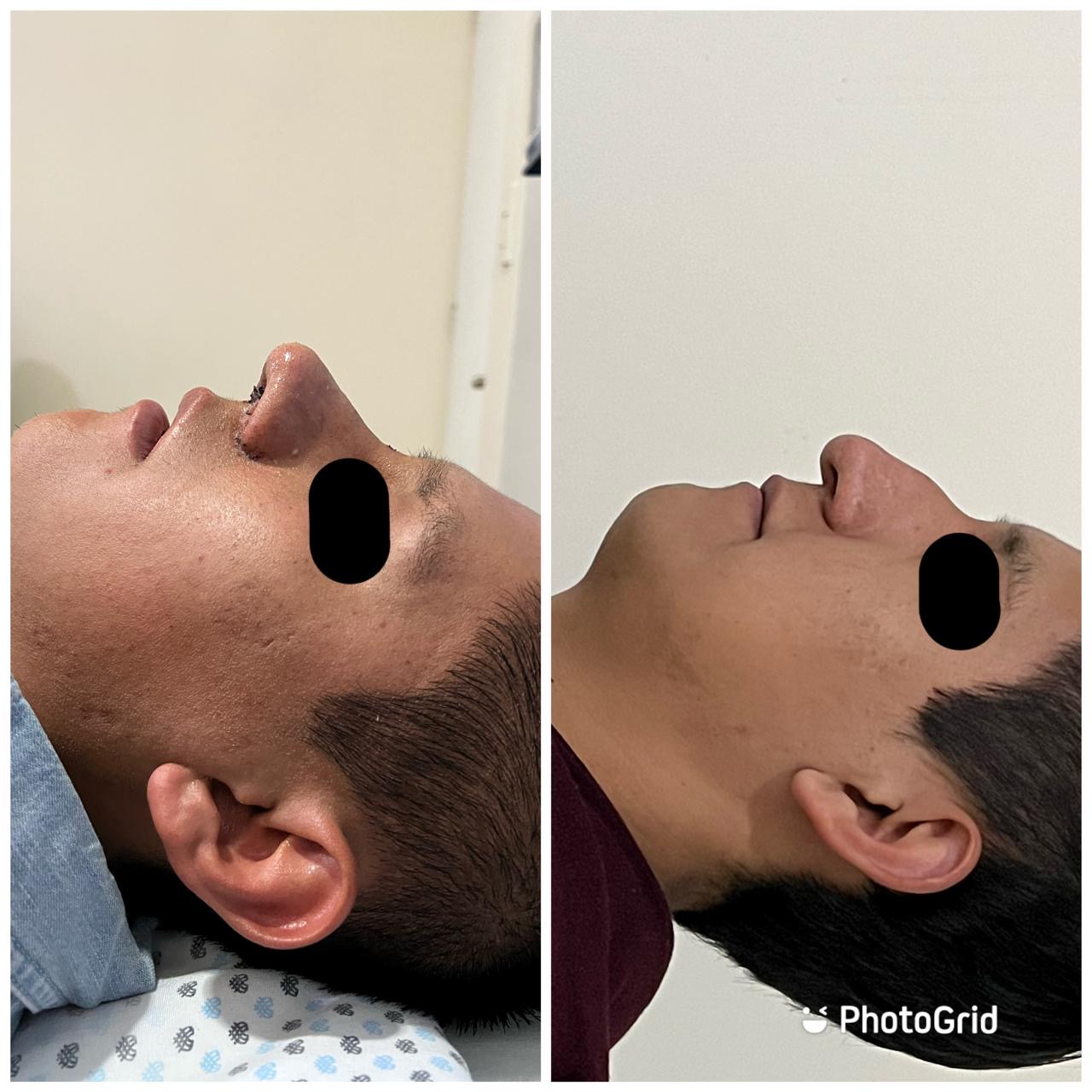 Resultados de blefaroplastía