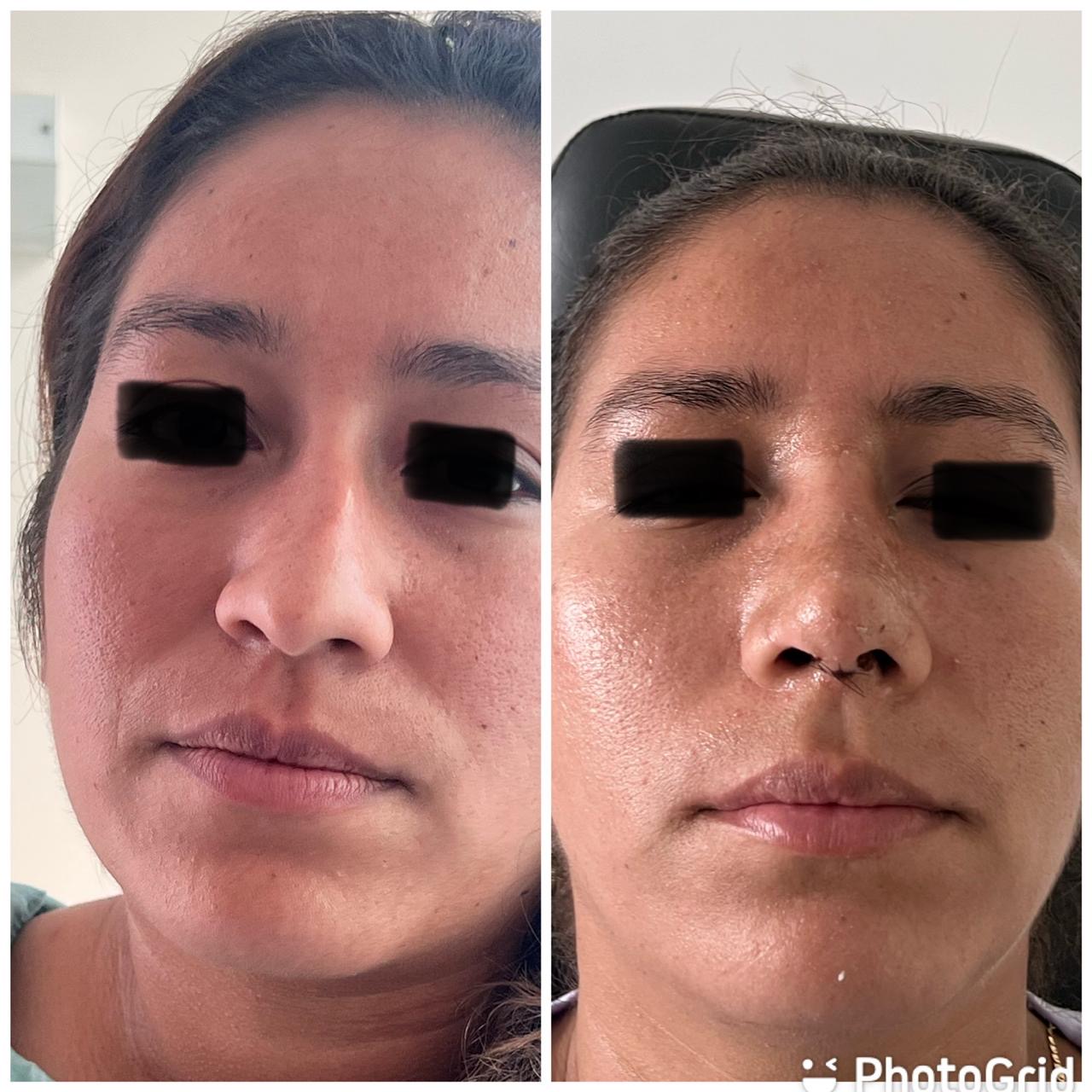 Resultados quirúrgicos