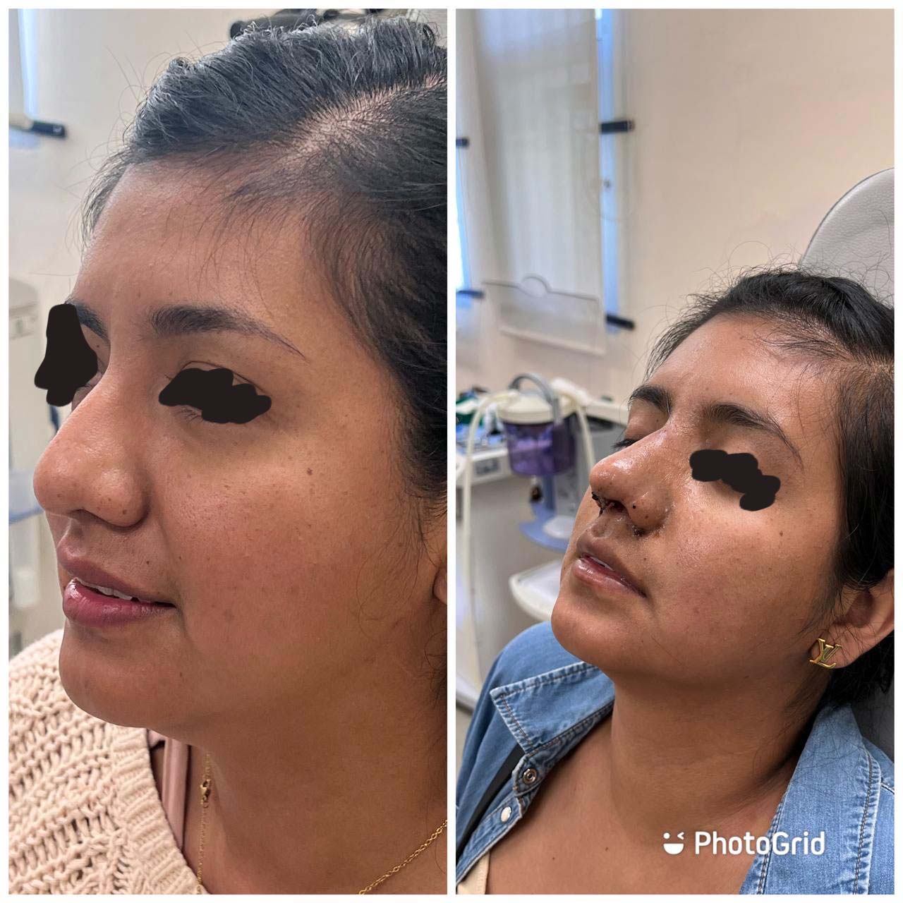 Equipos CPAP disponibles