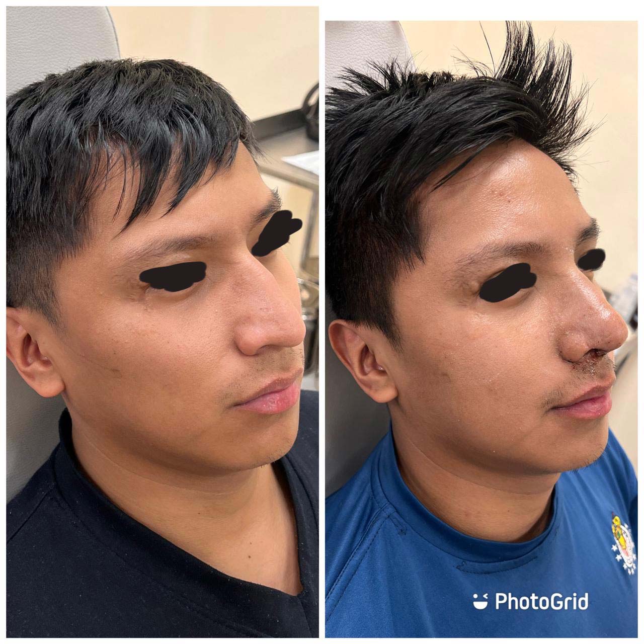 Resultados de rinoplastía